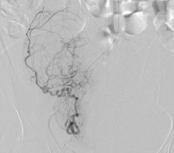 Angiogram Uterine Artery Fibroid